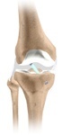 ACL Reconstruction Patellar Tendon