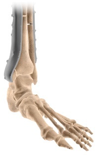 Ankle Fracture