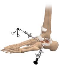 Ankle Sprain