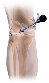 Arthroscopy of the Knee Joint
