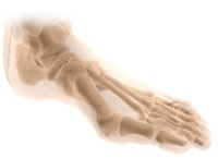 Bunion Surgery