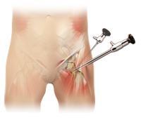 Hip Arthroscopy