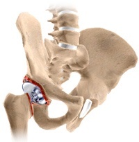 Revision Hip Replacement