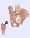 Total Hip Replacement (THR) 