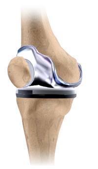 Total Knee Replacement