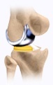 Uni Condylar Knee Replacement
