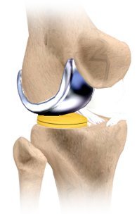 Unicondylar Knee Replacement